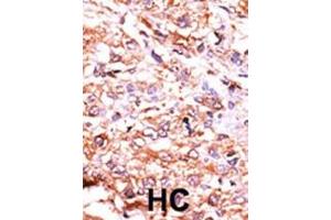 Formalin-fixed and paraffin-embedded human cancer tissue reacted with the primary antibody, which was peroxidase-conjugated to the secondary antibody, followed by AEC staining. (GUCY1A2 抗体  (N-Term))