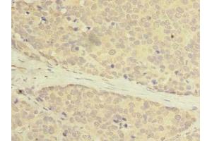 Immunohistochemistry of paraffin-embedded human gastric cancer using ABIN7175069 at dilution of 1: 100 (C2orf27A 抗体  (AA 3-174))