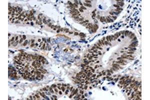 The image on the left is immunohistochemistry of paraffin-embedded Human colon cancer tissue using ABIN7191321(LRP5 Antibody) at dilution 1/55, on the right is treated with synthetic peptide.