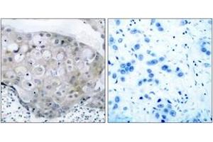 Immunohistochemistry analysis of paraffin-embedded human breast carcinoma, using VEGFR2 (Phospho-Tyr951) Antibody. (VEGFR2/CD309 抗体  (pTyr951))