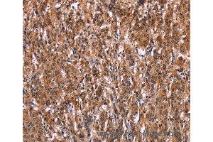 Immunohistochemistry of Human liver cancer using LILRB1 Polyclonal Antibody at dilution of 1:50 (LILRB1 抗体)