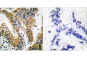 Peptide - +Immunohistochemical analysis of paraffin-embedded human lung carcinoma tissue, using CrkL (Ab-207) antibody (#B0067). (CrkL 抗体  (Tyr207))