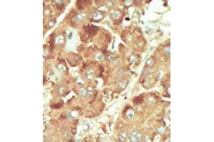 Formalin-fixed and paraffin-embedded human cancer tissue reacted with the primary antibody, which was peroxidase-conjugated to the secondary antibody, followed by DAB staining. (Nemo-Like Kinase 抗体  (C-Term))