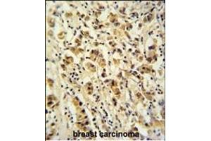 DDX49 Antibody (C-term) (ABIN653921 and ABIN2843155) immunohistochemistry analysis in formalin fixed and paraffin embedded human breast carcinoma followed by peroxidase conjugation of the secondary antibody and DAB staining. (DDX49 抗体  (C-Term))