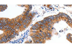 Immunohistochemistry of paraffin-embedded Human colon cancer tissue using KCNC2 Polyclonal Antibody at dilution 1:100 (KCNC2 抗体)