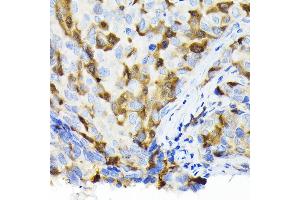 Immunohistochemistry of paraffin-embedded human breast cancer using Thymidine Kinase 1 Rabbit pAb (ABIN6132726, ABIN6149198, ABIN6149199 and ABIN6221245) at dilution of 1:100 (40x lens). (TK1 抗体  (AA 1-234))