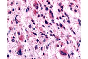 Anti-GABABR1 / GABBR1 antibody IHC of human Brain, Glioblastoma. (GABBR1 抗体  (N-Term))