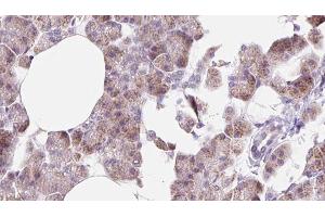 ABIN6273225 at 1/100 staining Human pancreas cancer tissue by IHC-P. (DCTN6 抗体  (Internal Region))