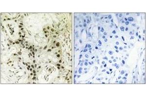 Immunohistochemistry analysis of paraffin-embedded human breast carcinoma tissue, using FOXI1 Antibody.