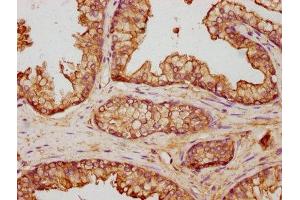 IHC image of ABIN7144281 diluted at 1:500 and staining in paraffin-embedded human prostate cancer performed on a Leica BondTM system. (Annexin V 抗体  (AA 2-320))