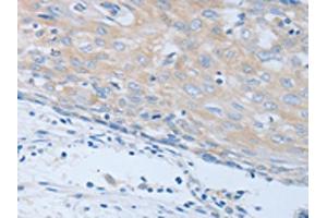 The image on the left is immunohistochemistry of paraffin-embedded Human cervical cancer tissue using ABIN7190248(CHRFAM7A Antibody) at dilution 1/40, on the right is treated with synthetic peptide. (CHRNA7 抗体)