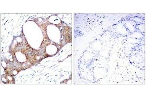 Immunohistochemical analysis of paraffin-embedded human breast carcinoma tissue using GSK3a(Phospho-Ser21) Antibody(left) or the same antibody preincubated with blocking peptide(right). (GSK3 alpha 抗体  (pSer21))