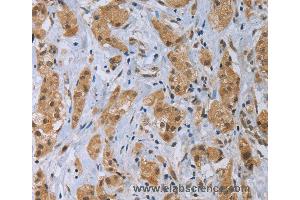 Immunohistochemistry of Human thyroid cancer using CLEC1A Polyclonal Antibody at dilution of 1:40