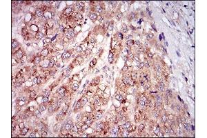 Immunohistochemical analysis of paraffin-embedded liver cancer tissues using MSTN mouse mAb with DAB staining. (MSTN 抗体  (AA 24-266))