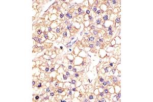 (ABIN387816 and ABIN2843905) staining EGFR in human hepatic carcinoma sections by Immunohistochemistry (IHC-P - paraformaldehyde-fixed, paraffin-embedded sections). (EGFR 抗体)