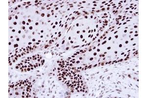 Immunohistochemical staining of paraffin-embedded Cal27 Xenograft using hnRNP C1/C2 antibody at a dilution of 1:100 (HNRNPC 抗体)