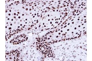 Immunohistochemical staining of paraffin-embedded Cal27 Xenograft using hnRNP C1/C2 antibody at a dilution of 1:100