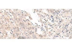 Immunohistochemistry of paraffin-embedded Human prost at e cancer tissue using OLA1 Polyclonal Antibody at dilution of 1:45(x200) (OLA1 抗体)