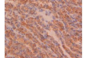 DAB staining on IHC-P; Samples: Human Thyroid cancer Tissue (PPIB 抗体  (AA 47-216))
