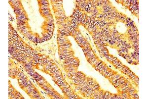 IHC image of ABIN7158752 diluted at 1:200 and staining in paraffin-embedded human colon cancer performed on a Leica BondTM system. (LPCAT2 抗体  (AA 442-544))