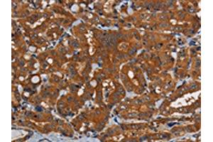 The image on the left is immunohistochemistry of paraffin-embedded Human thyroid cancer tissue using ABIN7191822(PDE5A Antibody) at dilution 1/50, on the right is treated with synthetic peptide. (PDE5A 抗体)