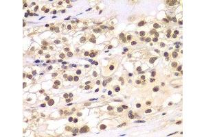 Immunohistochemistry of paraffin-embedded Human kidney cancer using ULK4 Polyclonal Antibody at dilution of 1:100 (40x lens). (ULK4 抗体)