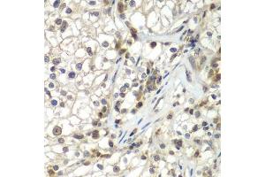 Immunohistochemistry of paraffin-embedded human kidney cancer using ASPSCR1 antibody. (ASPSCR1 抗体  (AA 284-553))