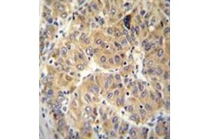 Immunohistochemistry analysis in formalin fixed and paraffin embedded human hepatocarcinoma reacted with NARS Antibody (N-term) followed which was  peroxidase conjugated to the secondary antibody and followed by DAB staining. (NARS 抗体  (N-Term))