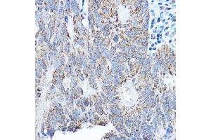 Immunohistochemistry of paraffin-embedded human colon carcinoma using SMOC1 antibody (ABIN7270511) at dilution of 1:250 (40x lens). (SMOC1 抗体  (AA 27-250))