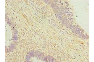 Immunohistochemistry of paraffin-embedded human ovarian cancer using ABIN7149808 at dilution of 1:100 (OTUD6B 抗体  (AA 1-293))