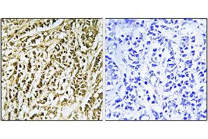 Immunohistochemistry analysis of paraffin-embedded human breast carcinoma tissue using FEN1 antibody. (FEN1 抗体)