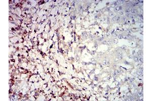 Immunohistochemical analysis of paraffin-embedded stomach cancer tissues using CD39 mouse mAb with DAB staining. (CD39 抗体  (AA 38-179))