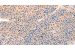 Immunohistochemistry of paraffin-embedded Human liver cancer tissue using CD109 Polyclonal Antibody at dilution 1:30 (CD109 抗体)