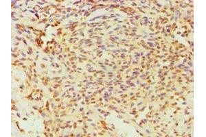 Immunohistochemistry of paraffin-embedded human breast cancer using ABIN7170761 at dilution of 1:100 (ESRRA 抗体  (AA 1-423))