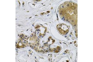 Immunohistochemistry of paraffin-embedded human breast cancer using NCF4 Antibody (ABIN5971122) at dilution of 1/100 (40x lens). (NCF4 抗体)