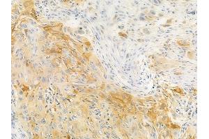ABIN6256940 and ABIN6274855 at 1/100 staining human tongue carcinoma by IHC-P. (Apolipoprotein F 抗体  (C-Term))
