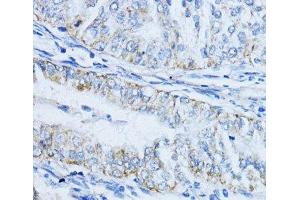 Immunohistochemistry of paraffin-embedded Human colon carcinoma using VIL1 Polyclonal Antibody at dilution of 1:100 (40x lens). (Villin 1 抗体)