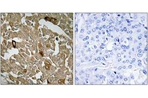 Immunohistochemistry analysis of paraffin-embedded human breast carcinoma tissue, using BTBD6 Antibody. (BTBD6 抗体  (AA 91-140))