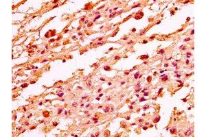 IHC image of nme1HU diluted at 1:50 and staining in paraffin-embedded human melanoma performed on a Leica BondTM system. (Histone H1-Like (LOC107807853) 抗体)