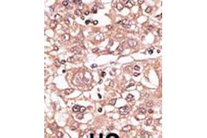 Formalin-fixed and paraffin-embedded human cancer tissue reacted with the primary antibody, which was peroxidase-conjugated to the secondary antibody, followed by AEC staining. (TLR7 抗体  (N-Term))