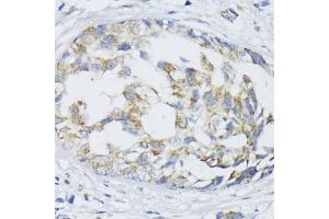 Immunohistochemistry of paraffin-embedded human mammary cancer using SLC30 antibody (2532) at dilution of 1:100 (40x lens). (SLC30A1 抗体  (AA 250-350))