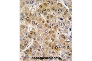 Formalin-fixed and paraffin-embedded human hepatocarcinoma tissue reacted with DDX5 antibody (C-term) (ABIN391668 and ABIN2841579) , which was peroxidase-conjugated to the secondary antibody, followed by DAB staining. (DDX5 抗体  (C-Term))