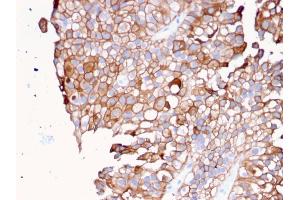 Formalin-fixed, paraffin-embedded human Urothelial Carcinoma stained with Uroplakin 1B Mouse Monoclonal Antibody (UPK1B/3081). (Uroplakin 1B 抗体  (AA 109-229))