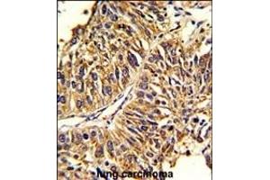 Formalin-fixed and paraffin-embedded human lung carcinoma reacted with HMGCS1 Antibody (Center), which was peroxidase-conjugated to the secondary antibody, followed by DAB staining. (HMGCS1 抗体  (AA 290-317))