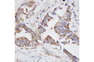Anti-Osteopontin antibody, IHC(P) IHC(P): Human Mammary Cancer Tissue (Osteopontin 抗体  (N-Term))