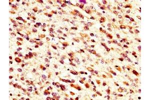 IHC image of ABIN7159800 diluted at 1:300 and staining in paraffin-embedded human glioma performed on a Leica BondTM system. (m1ip1 抗体  (AA 1-183))