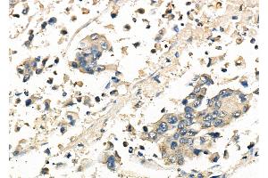 ABIN6261815 and ABIN6278146 at 1/100 staining Human gastric cancer by IHC-P.