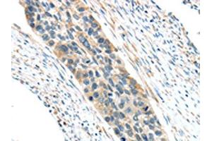 The image on the left is immunohistochemistry of paraffin-embedded Human esophagus cancer tissue using ABIN7193036(VWCE Antibody) at dilution 1/30, on the right is treated with synthetic peptide. (VWCE 抗体)