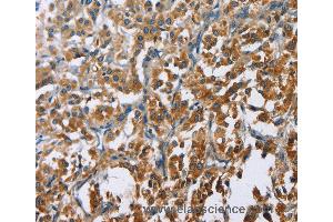 Immunohistochemistry of Human cervical cancer using CARD9 Polyclonal Antibody at dilution of 1:60 (CARD9 抗体)