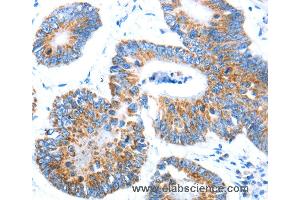 Immunohistochemistry of Human colon cancer using AIFM1 Polyclonal Antibody at dilution of 1:30 (AIF 抗体)